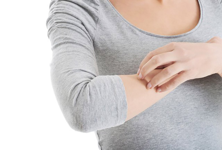 Dị ứng thuốc muỗi có nguy hiểm không? Cách xử lý - BIOCARE
